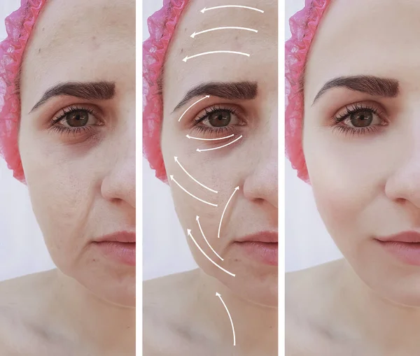 Woman Wrinkles Face Correction Procedures Arrow — Stock Photo, Image