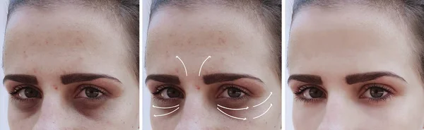 Frau Falten Gesicht Korrektur Vor Und Nach Eingriffen Pfeil — Stockfoto