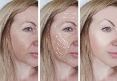 woman facial wrinkles correction before and after procedures arrow clipart