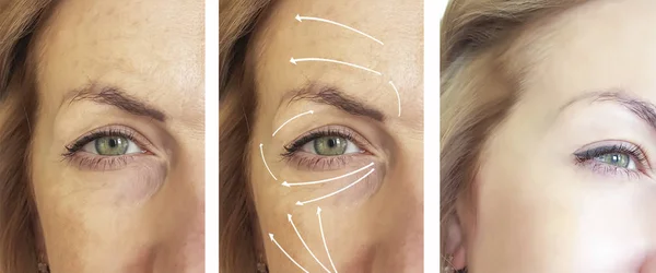 Woman Facial Wrinkles Correction Procedures Arrow — Stock Photo, Image