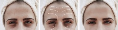 kadın kırışıklıkları yüz önce ve sonra düzeltme, ok