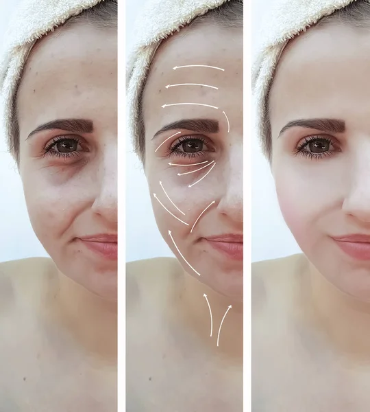 Mujer Arrugas Cara Antes Después Corrección Flecha — Foto de Stock