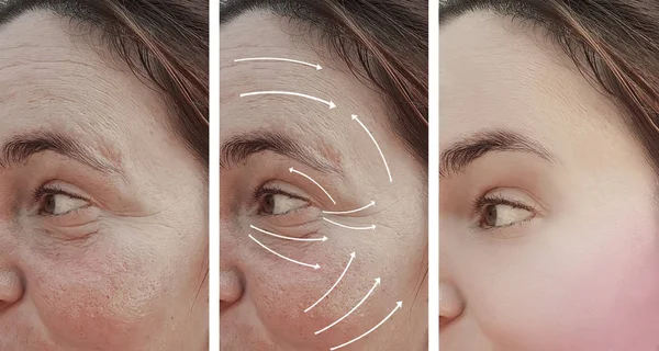 Wanita Keriput Wajah Sebelum Dan Setelah Koreksi Panah — Stok Foto