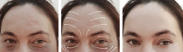 woman wrinkles face before and after correction, arrow