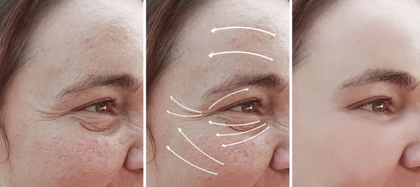 Woman Wrinkles Face Correction Arrow — Stock Photo, Image