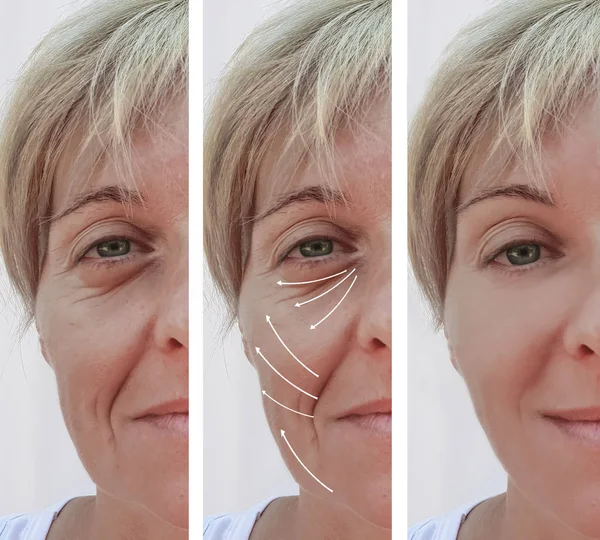 Frau Gesichtsfaltenkorrektur Vor Und Nach Eingriffen Pfeil — Stockfoto