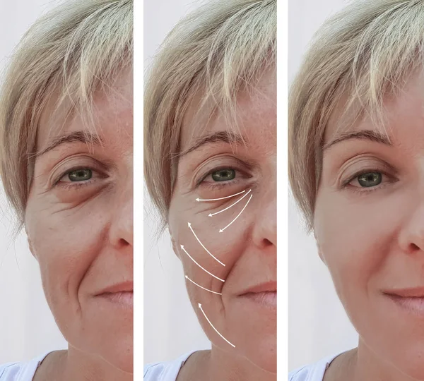 Woman Face Wrinkles Correction Procedures Arrow — Stock Photo, Image