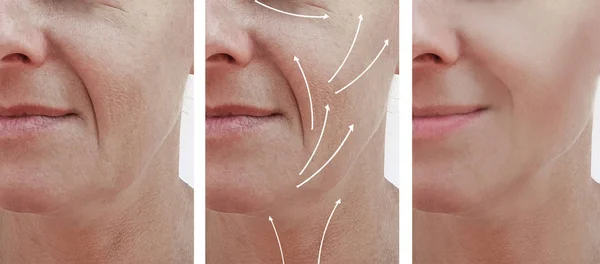 Woman Face Wrinkles Correction Procedures Arrow — Stock Photo, Image