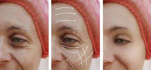 Mujer Cara Arrugas Corrección Antes Después Los Procedimientos Flecha — Foto de Stock