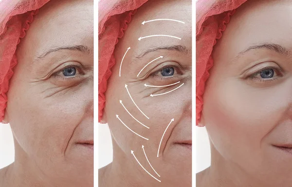 Woman Face Wrinkles Correction Procedures Arrow — Stock Photo, Image