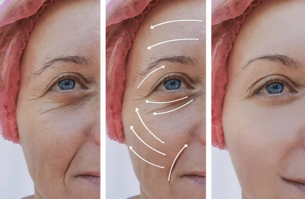 Woman Face Wrinkles Correction Procedures Arrow — Stock Photo, Image