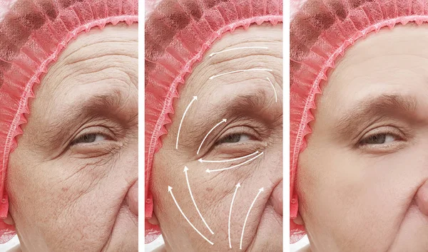 Wanita Keriput Wajah Sebelum Dan Setelah Prosedur Koreksi Panah — Stok Foto