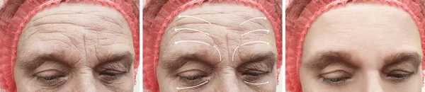 Woman Wrinkles Face Correction Procedures Arrow — Stock Photo, Image