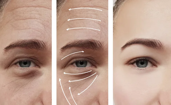 Woman Wrinkles Face Correction Procedures — Stock Photo, Image