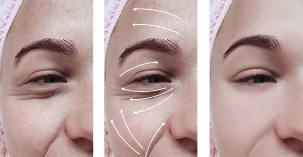 Kadın Kırışıklıkları Yüz Öncesi Sonrası Düzeltme Işlemleri — Stok fotoğraf