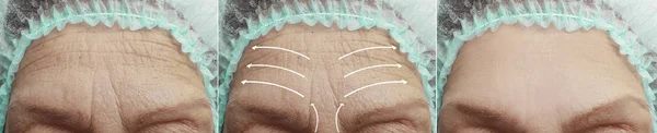 Elderly Woman Face Wrinkles Correction Procedures — Stock Photo, Image