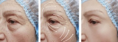 elderly woman face wrinkles before and after correction procedures clipart