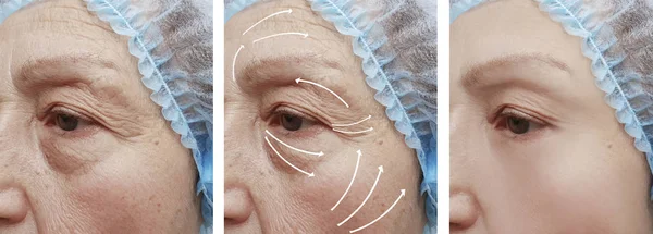 Ηλικιωμένη Γυναίκα Τις Ρυτίδες Στο Πρόσωπο Πριν Και Μετά Από — Φωτογραφία Αρχείου