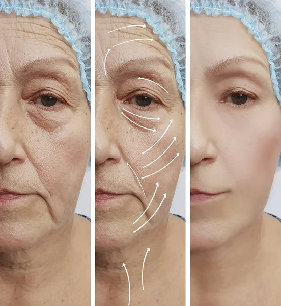 Elderly Woman Face Wrinkles Correction Procedures — Stock Photo, Image