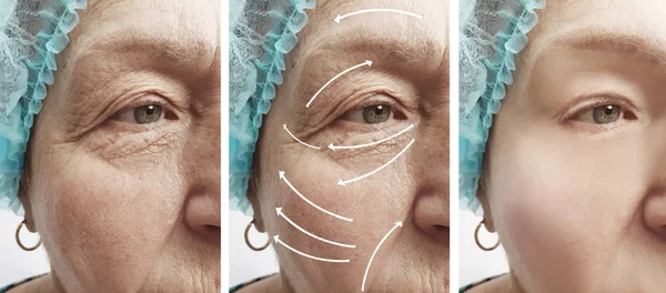 老年妇女在矫正程序前后面临皱纹 — 图库照片