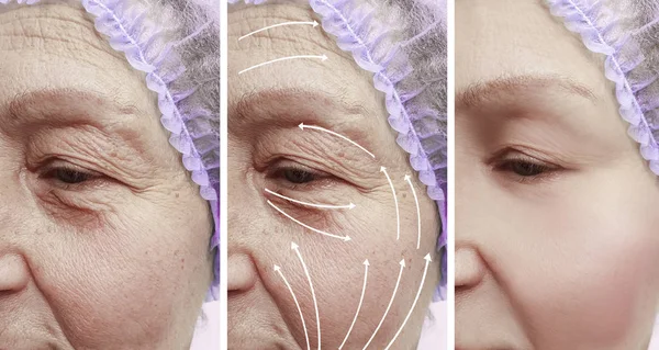 Elderly Woman Face Wrinkles Correction Procedures — Stock Photo, Image