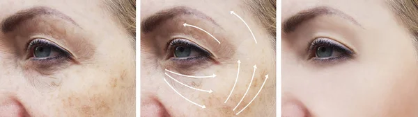 Wanita Keriput Wajah Sebelum Dan Setelah Prosedur Koreksi — Stok Foto