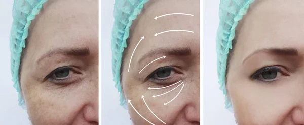 woman wrinkles face before and after correction procedures