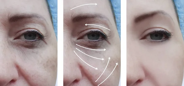 Frauenfalten Gesicht Vor Und Nach Korrekturmaßnahmen — Stockfoto