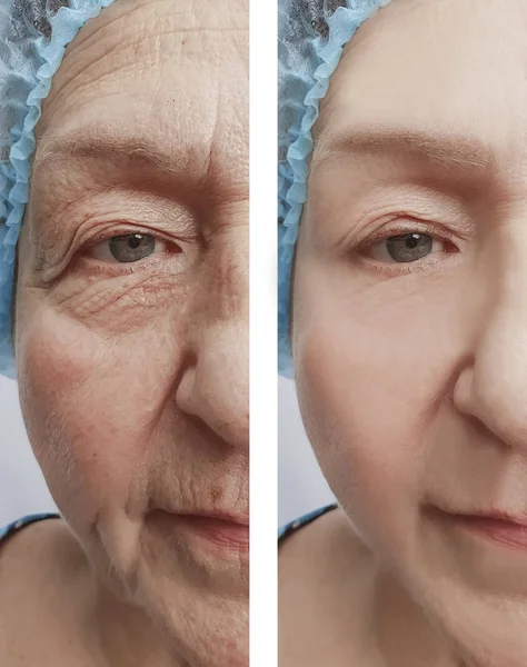 老女人皱纹之前和之后美容师程序 — 图库照片