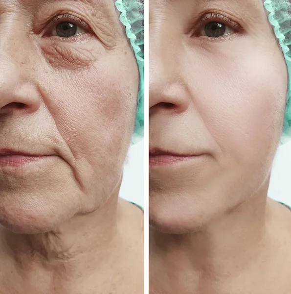 Face Old Woman Wrinkles Procedures — Stock Photo, Image