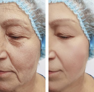 Yaşlı bir kadının yüz kırışıklıklar önce ve sonra yordamları