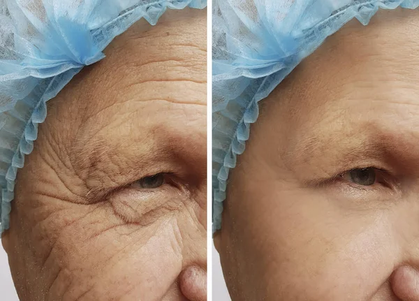 face of an old man wrinkles before and after procedures
