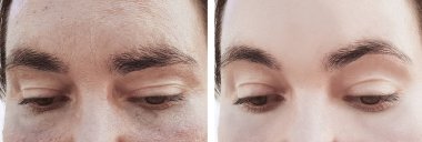 kadın kırışıklıkları yüz öncesi ve sonrası yordamları