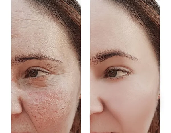 妇女皱纹面孔在规程之前和之后 — 图库照片