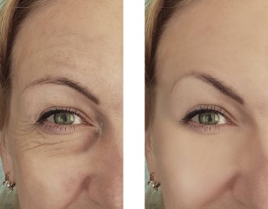 kadın kırışıklıkları öncesi ve tedavi sonrası