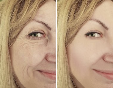kadın kırışıklıkları öncesi ve tedavi sonrası