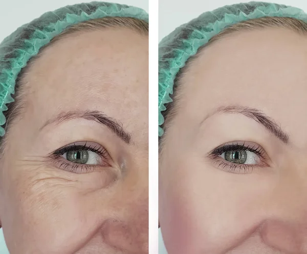 Arrugas Mujer Antes Después Los Tratamientos —  Fotos de Stock
