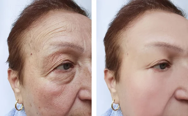 Arrugas Ancianas Antes Después Los Tratamientos —  Fotos de Stock