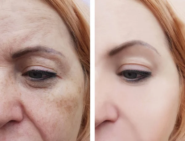 Kvinna Ansikte Rynkor Pigmentering Före Och Efter Förfaranden — Stockfoto