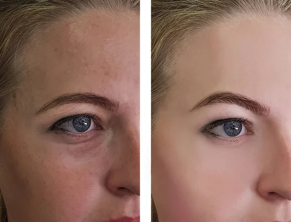 Öncesi Tedavi Sonrası Kız Gözleri Kırışıyor — Stok fotoğraf