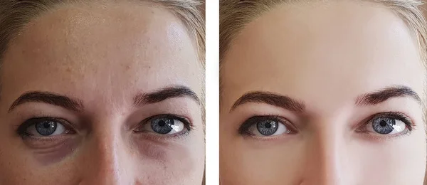 Menina Rugas Olhos Antes Depois Procedimentos — Fotografia de Stock