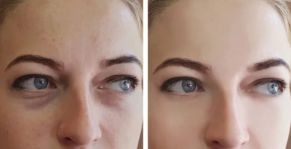 Menina Rugas Olhos Antes Depois Procedimentos — Fotografia de Stock