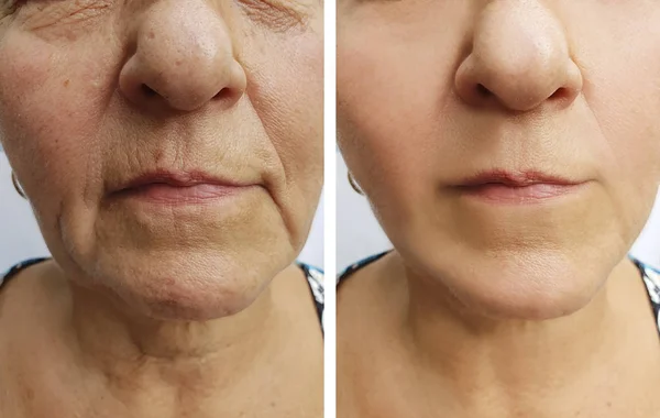 Ältere Frau Falten Gesicht Vor Und Nach Dem Eingriff — Stockfoto