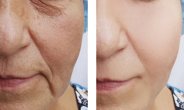 Elderly Woman Wrinkles Face Procedure — Stock Photo, Image