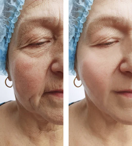 Elderly Woman Wrinkles Face Procedure — Stock Photo, Image