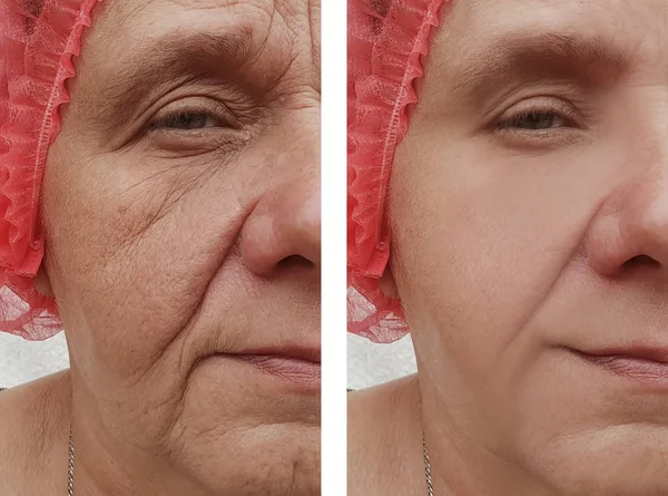 Elderly Woman Facial Wrinkles Correction Procedures — Stock Photo, Image