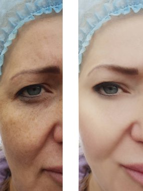 kadın yüz kırışıklıkları öncesi ve sonrası düzeltme işlemleri