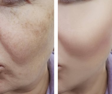 kadın yüz kırışıklıkları öncesi ve sonrası düzeltme işlemleri