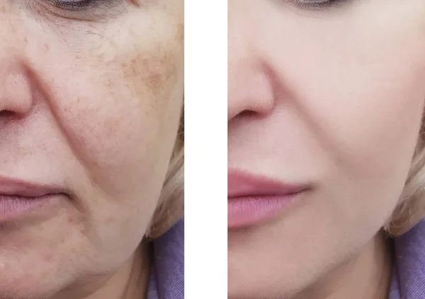 Woman Facial Wrinkles Correction Procedures — Stock Photo, Image