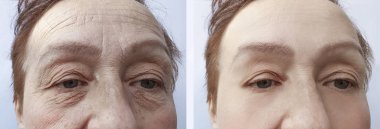 Yaşlı kadın öncesi ve sonrası yordamları yüz